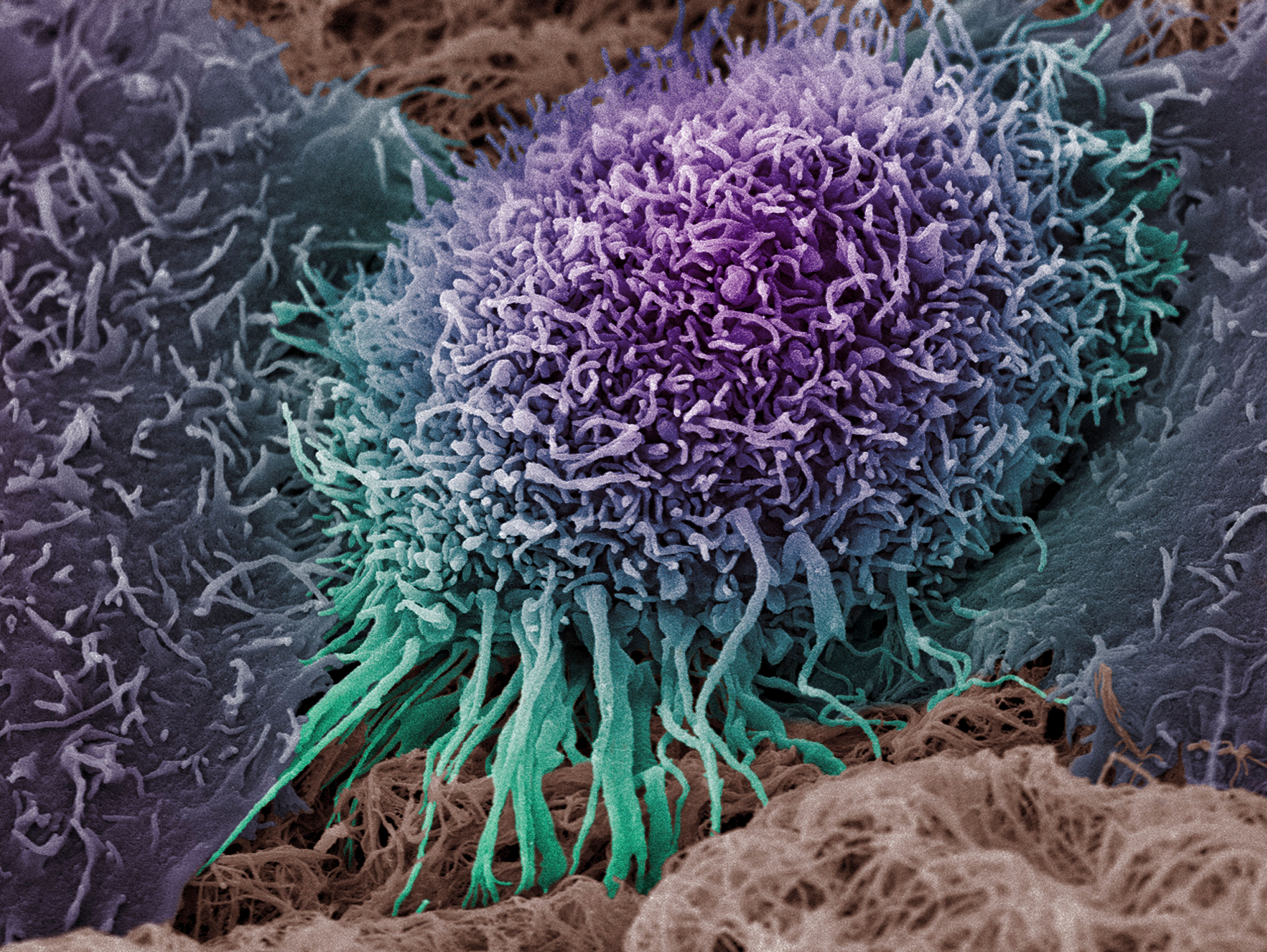 A colorized scanning electron micrograph of a human oral squamous carcinoma cell, the most common form of head and neck cancer. 