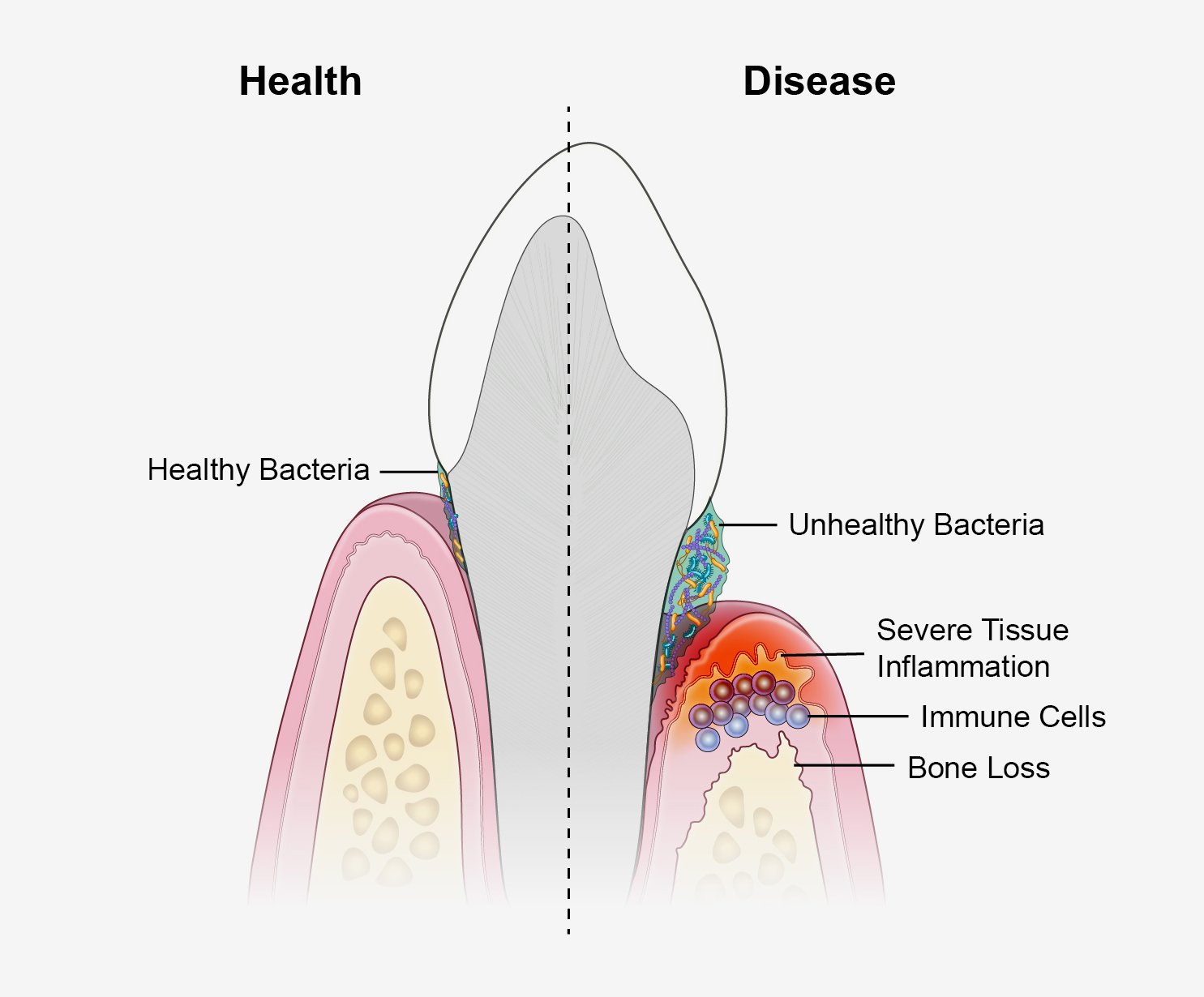 Image contrasts healthy gum tissue (left) and chronic periodontal disease (right).