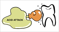 Illustration: Tooth vs. ACID ATTACK