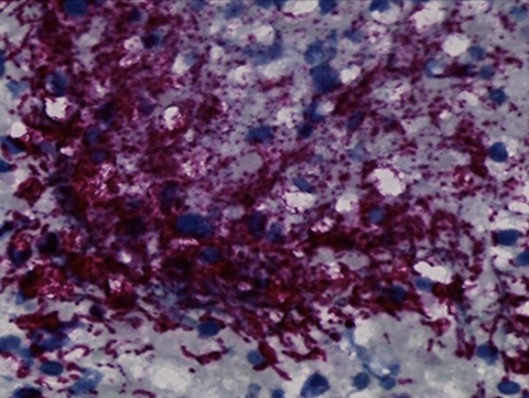Fusobacterium nucleatum bacteria (purple) in a human colorectal cancer tumor. 