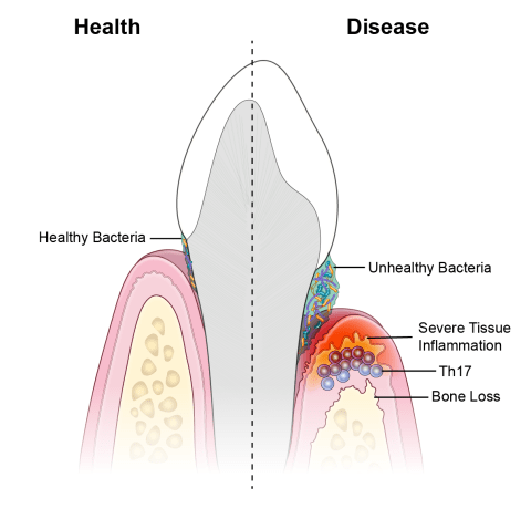 Illustration of tooth shows intact gum tissues in presence of healthy bacteria on the left; right side shows gum inflammation and bone loss in presence of unhealthy bacteria.