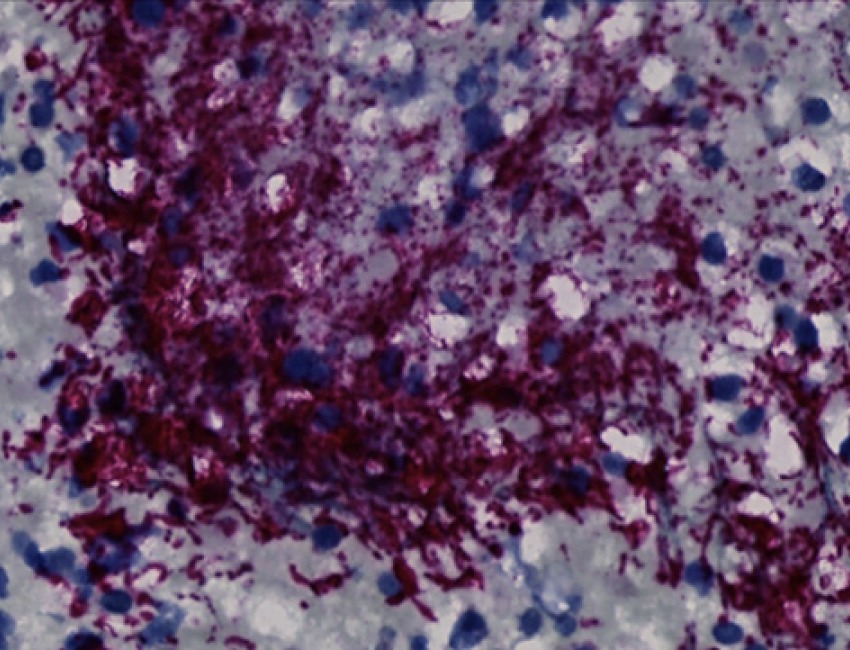 Fusobacterium nucleatum bacteria (purple) in a human colorectal cancer tumor. 