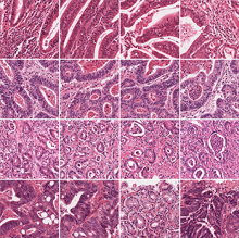 By detecting different visual patterns in tumor images, the deep learning program accurately predicted the presence or absence of molecular alterations, such as the mutated AMER1 gene, which is present in the gastric tumor images on the left but not the right. Such findings might affect treatment strategies for patients.