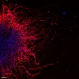 Image of oral cancer cells sending growth signals to nearby mouse sensory neurons via sprout projections called neurites.
