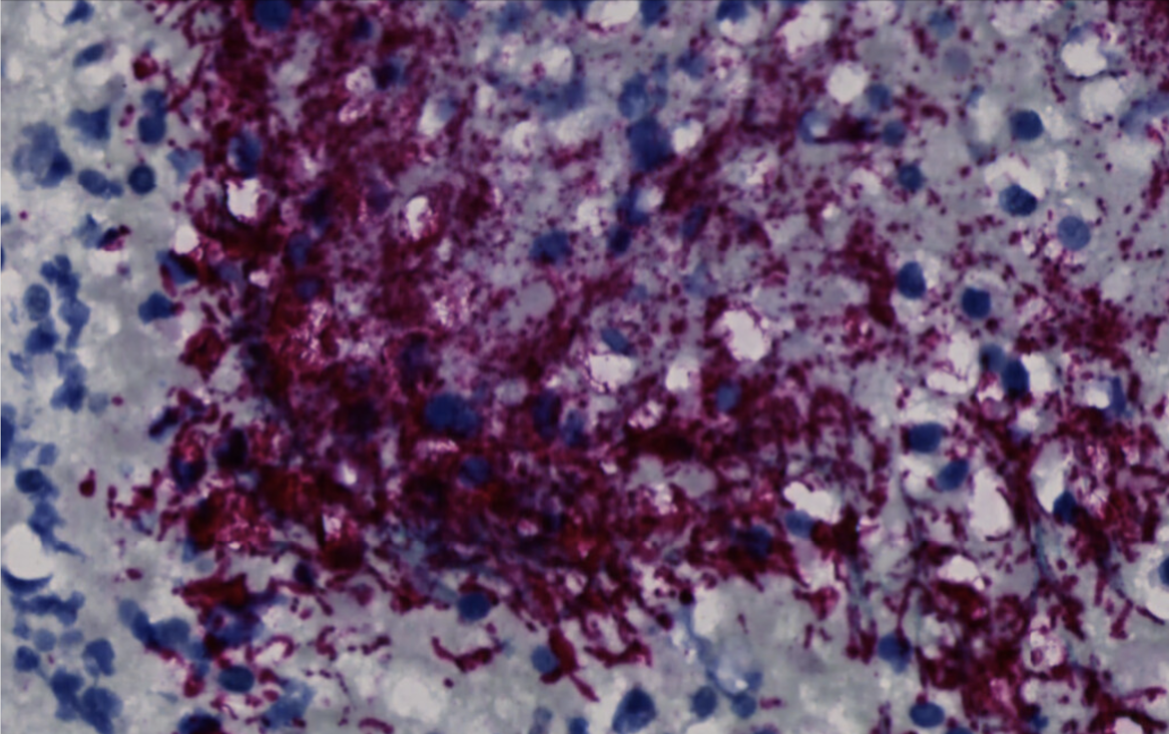 Fusobacterium nucleatum bacteria (purple) in a human colorectal cancer tumor.