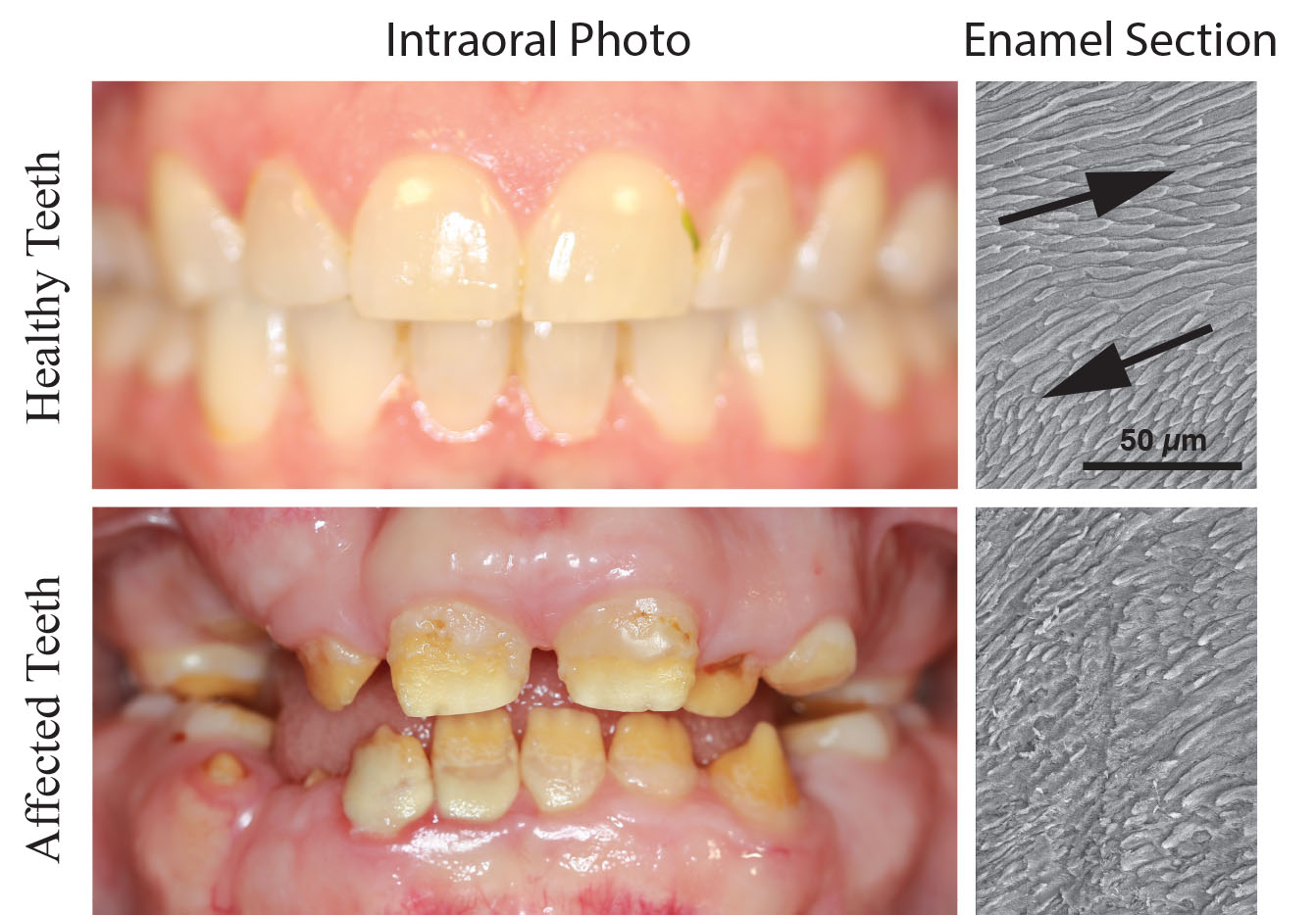 Pictures showing healthy teeth (upper panel) and severe erosion of enamel in affected teeth (lower panel). Images of enamel sections show the crisscross pattern of mineral rods in healthy enamel (arrows) and the loss of this pattern in affected enamel.