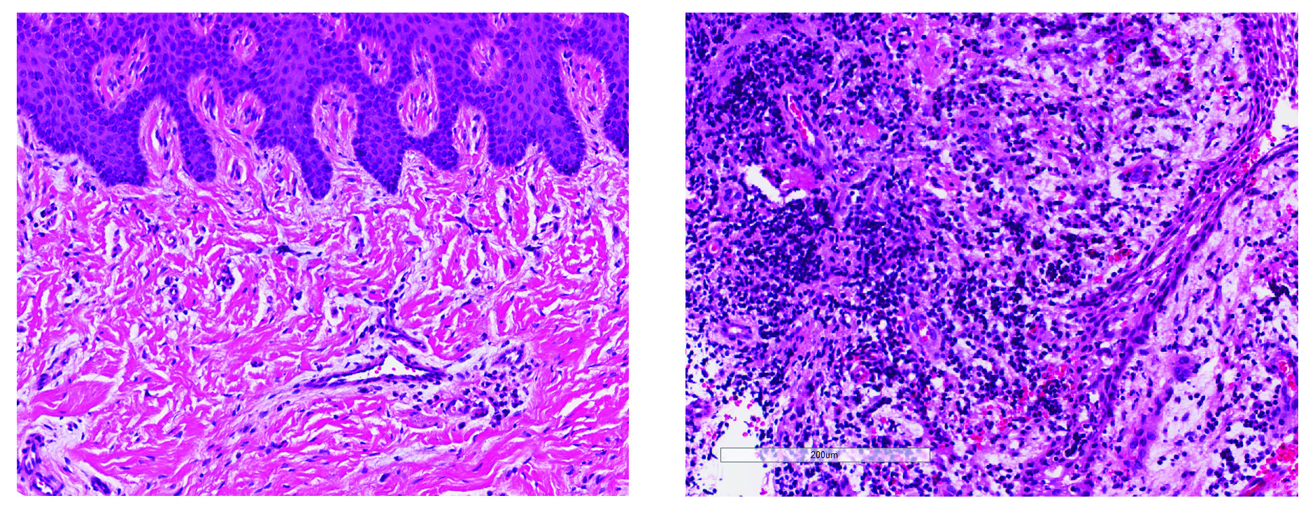 healthy gums (left), diseased gums (right)