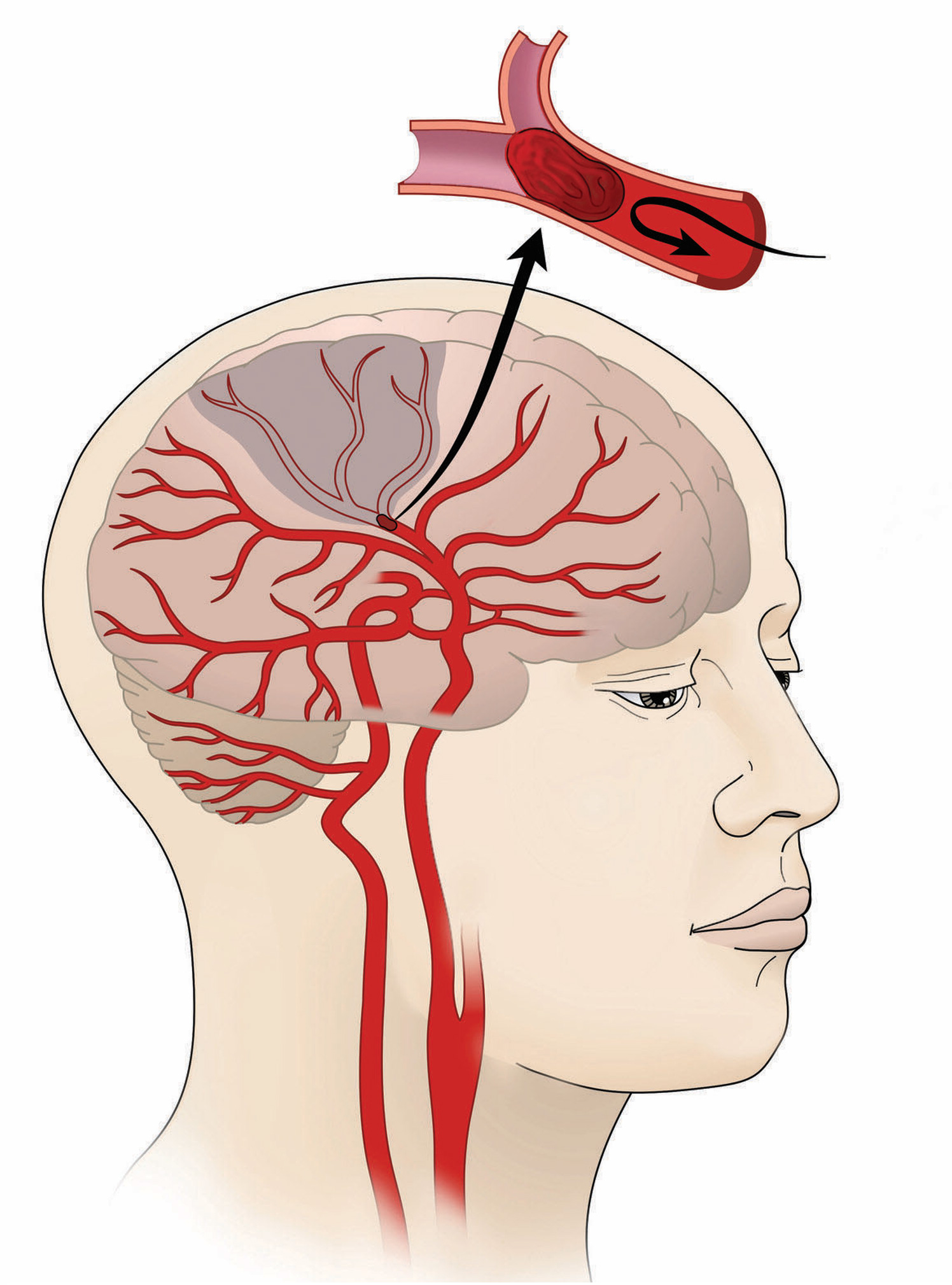 A stroke occurs when a blood vessel in the brain becomes blocked by a blood clot. 