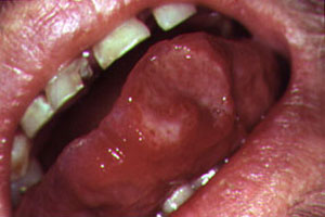 hiv symptoms on lips