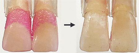 Biofilms grown on human teeth (left, stained pink for visibility) were almost entirely scrubbed off by the microrobots (right). 