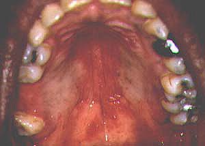 hiv symptoms mouth