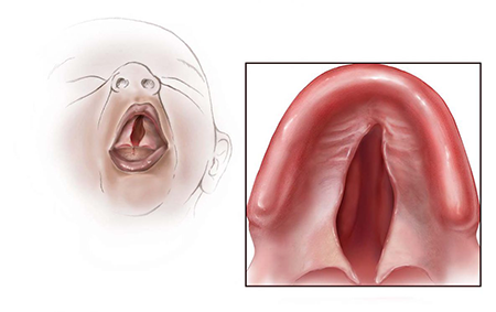 Sketch of newborn with an isolated cleft (l), a close-up sketch of a cleft palate (r).