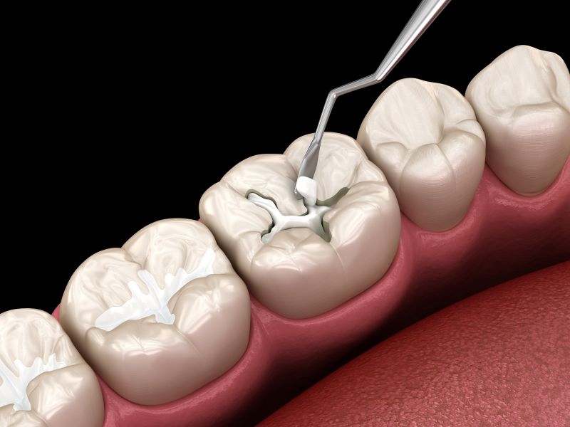 A close-up depiction of dental materials being applied to a tooth.