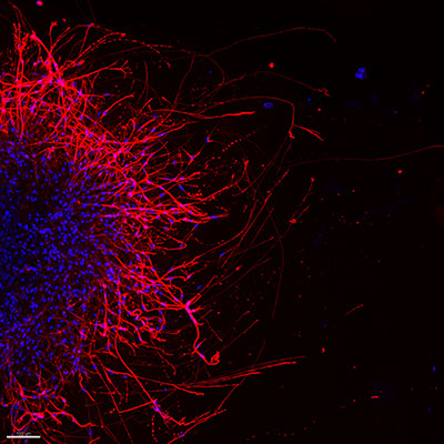 Image of oral cancer cells sending growth signals to nearby mouse sensory neurons via sprout projections called neurites.
