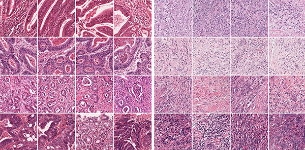 Detecting visual patterns in tumor images