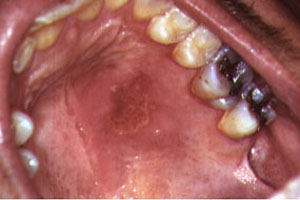 hiv symptoms mouth