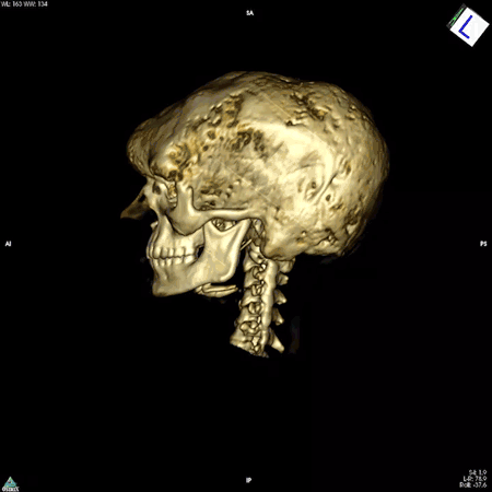 FD/MAS bone lesions can cause the skeleton to expand, as shown in this 3D rendering of a patient’s skull. | Alison Boyce