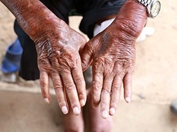 A close-up of the hands of a person with systemic sclerosis.