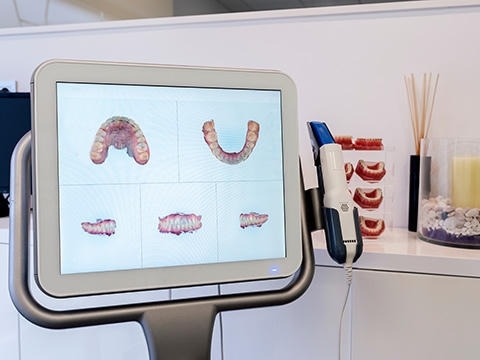 Digital dental scanner displaying 3D images of teeth and jaw on a monitor.