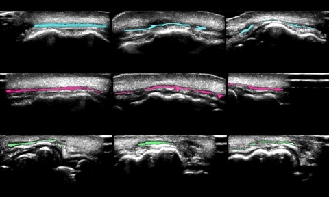   These images are cross sections of the upper lip taken by high resolution ultrasound in order to visualize the orbicularis oris muscles—colored in the images.