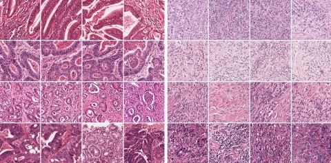 A collage of tumor tissues.