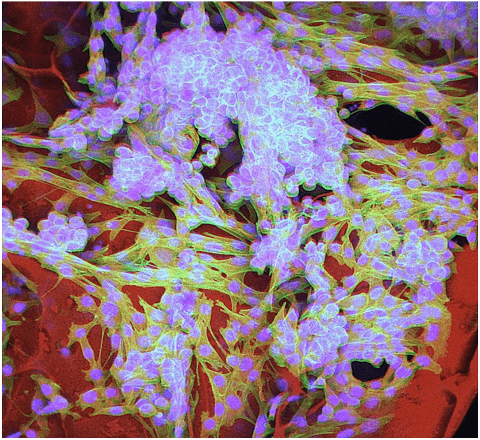 Cancerous melanoma cells.