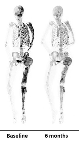 Bone scans of a patient before (left) and after (right) a six-month denosumab treatment show reduced turnover within fibrous dysplasia lesions (dark-colored patches). 
