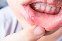 An image of a canker sore.