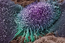 A colorized scanning electron micrograph of a human oral squamous carcinoma cell, the most common form of head and neck cancer.
