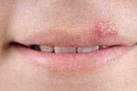An image of a fever blister.