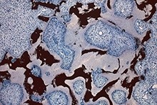 A microscopic view of Fibrous Dysplasia/McCune-Albright syndrome