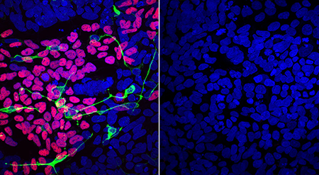 Compared to a disease-free mother (left), differentiated LINKED patient cells (right) lack markers of normal development of the brain, spinal cord and craniofacial skeleton (pink, green, yellow). |Werner lab, NIDCR