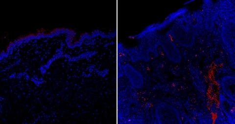 Compared to healthy human skin (left), skin from people with psoriasis had elevated levels of the cytokine oncostatin M (red), which was found to intensify itch responses in mice. 
