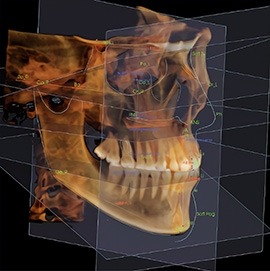 Human head CBCT scan with annotated cephalometric.