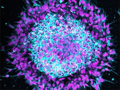 Yamada cancer cell spheroid.