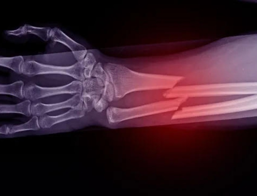 X-ray of a bone fracture in the arm