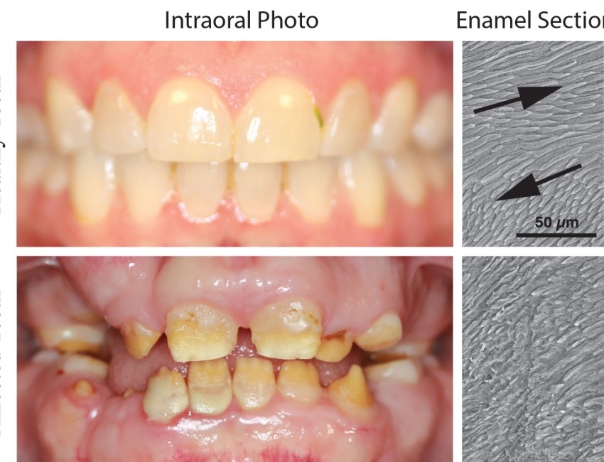 Pictures showing healthy teeth (upper panel) and severe erosion of enamel in affected teeth (lower panel). Images of enamel sections show the crisscross pattern of mineral rods in healthy enamel (arrows) and the loss of this pattern in affected enamel.