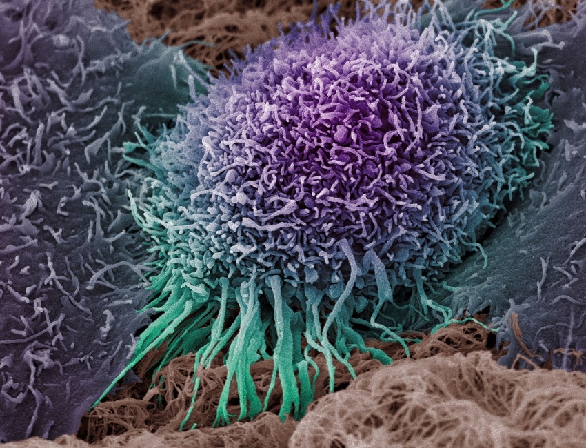 A colorized scanning electron micrograph of a human oral squamous carcinoma cell, the most common form of head and neck cancer. 