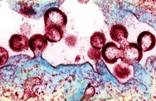 HIV virions budding from an infected cell under a microscope