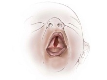 Sketch of newborn with an isolated cleft.