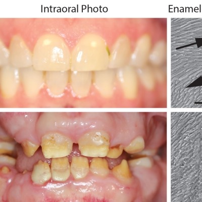 Pictures showing healthy teeth (upper panel) and severe erosion of enamel in affected teeth (lower panel). Images of enamel sections show the crisscross pattern of mineral rods in healthy enamel (arrows) and the loss of this pattern in affected enamel.