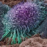 A colorized scanning electron micrograph of a human oral squamous carcinoma cell, the most common form of head and neck cancer. 