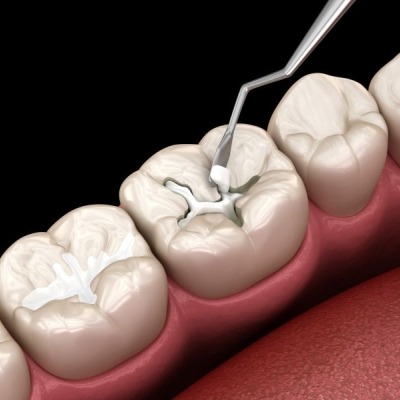 A close-up depiction of dental materials being applied to a tool.