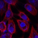 Image of oral cancer cells.