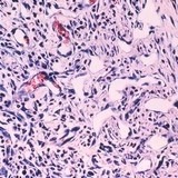 Kaposi's sarcoma cells (Source: National Cancer Institute)