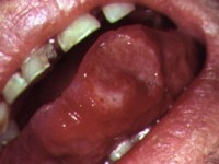 Aphthous ulcer