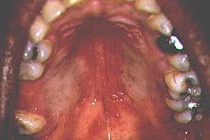 Candidiasis