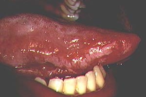Leucoplasia vellosa 
